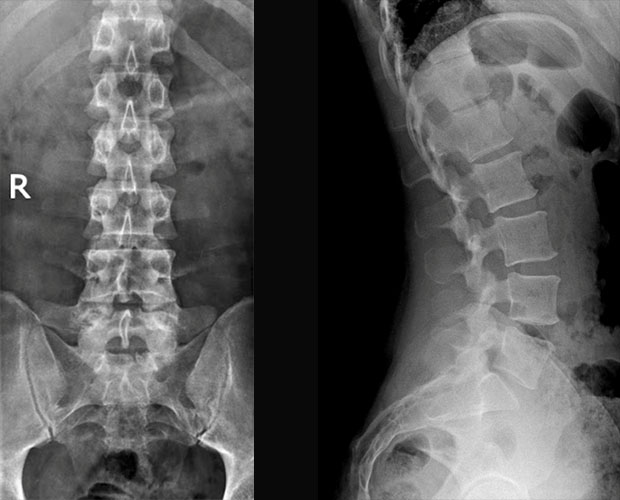 radiografia-della-colonna-lombo-sacrale